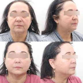 before-after photo tightening-of-facial-skin-facelift