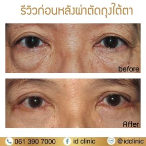 before-after photo plastika-niznego-veka