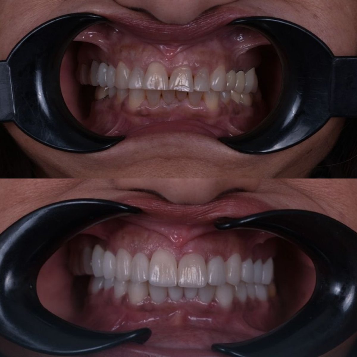 نتائج قبل وبعد ابتسامة هوليود في Dentavie Istanbul Dental Clinic، تجميل الابتسامة