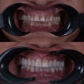 before-after photo hollywood-smile