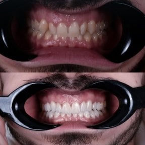 before-after photo hollywood-smile