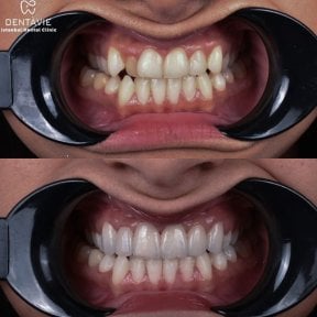 before-after photo hollywood-smile