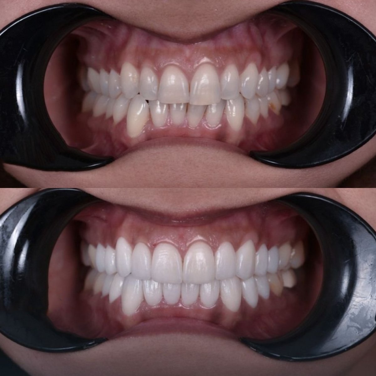 Antes y después de carillas Hollywood Smile en Dentavie Istanbul Dental Clinic, dientes más blancos