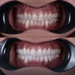 before-after photo hollywood-smile