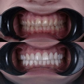 before-after photo hollywood-smile