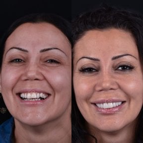 before-after photo hollywood-smile