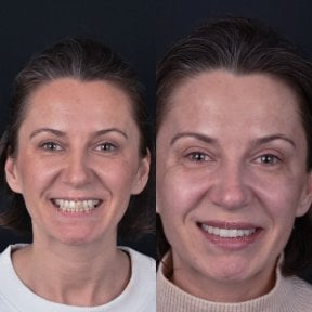 before-after photo hollywood-smile