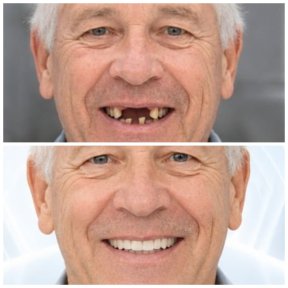 before-after photo dental-implant
