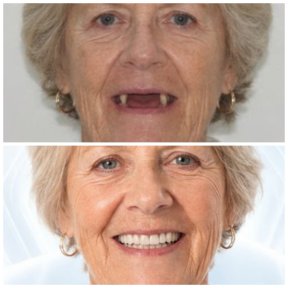 before-after photo dental-implant