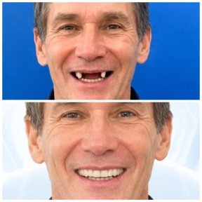before-after photo dental-implant