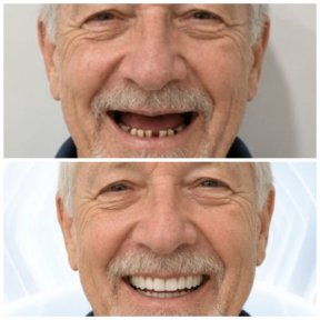before-after photo dental-implant
