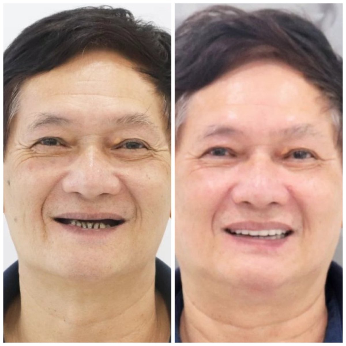 نتائج قبل وبعد زراعة الأسنان مع التاج في مركز Lac Viet Intech Dental Center، ابتسامة محسنة