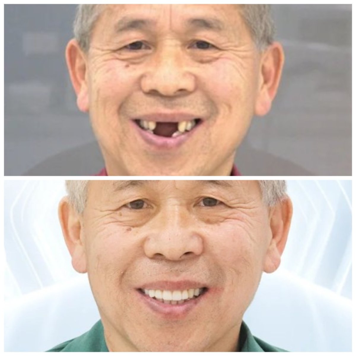 Resultados antes y después de implante dental con corona en Lac Viet Intech Dental Center, sonrisa restaurada