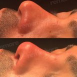 Vorher-nachher-Rhinoplastik-Ergebnis im Memorial Bahçelievler Hospital, verbesserte Nasenform