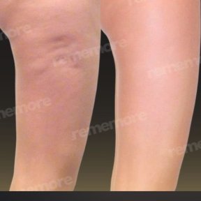 before-after photo thigh-lift