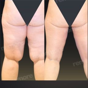 before-after photo thigh-lift