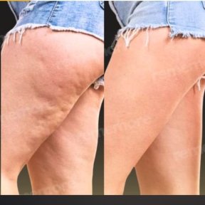 before-after photo thigh-lift
