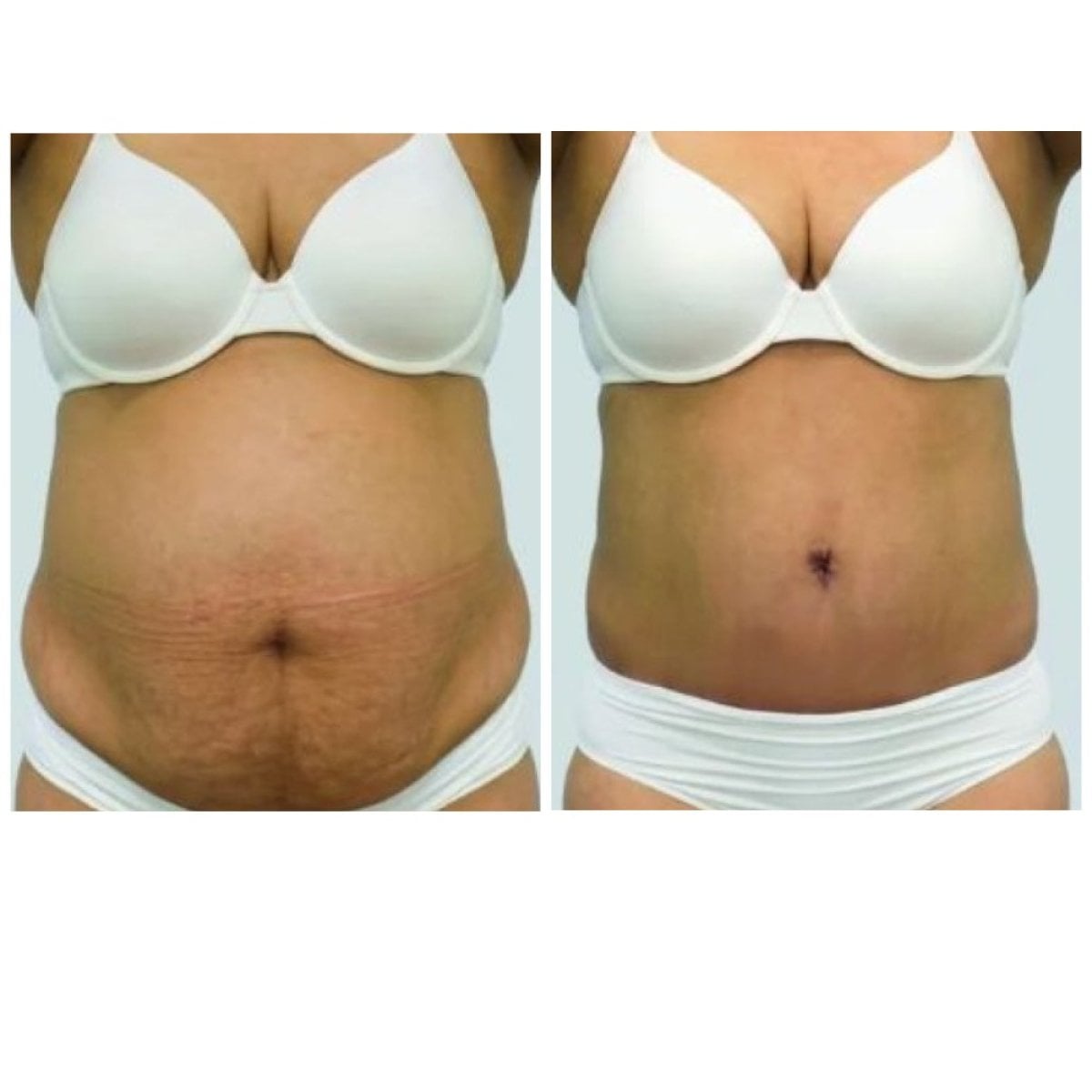 Resultados de abdominoplastia antes y después en YOUNIFY Clinic – abdomen más plano