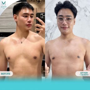 before-after photo operacia-pri-ginekomastii
