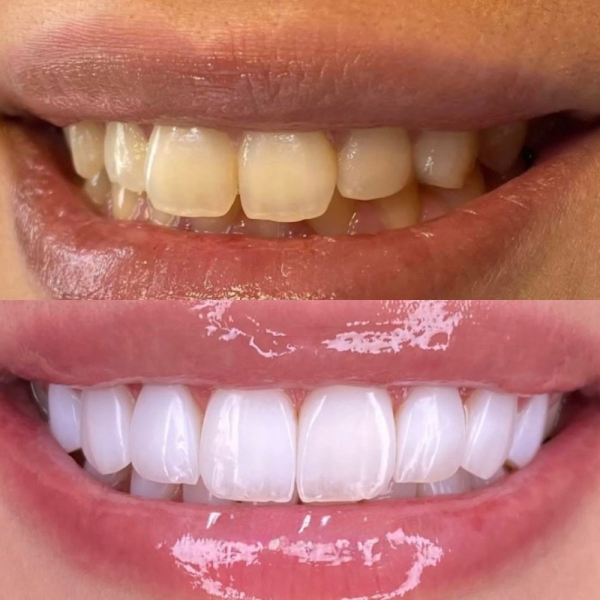 Antes y después de carillas dentales en Hegazy Dental Clinic – sonrisa más blanca