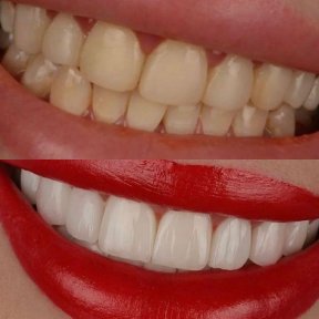before-after photo smile-makeover