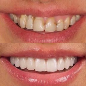 before-after photo smile-makeover
