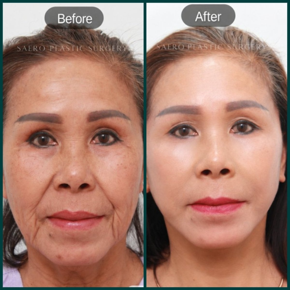 Resultados antes y después de lifting facial deep plane en SAERO Plastic Surgery, rejuvenecimiento