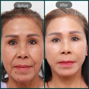 before-after photo deep-plane-facelift