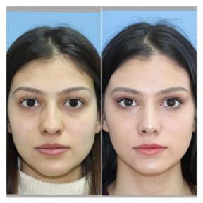 before-after photo rhinoplasty-nose-job