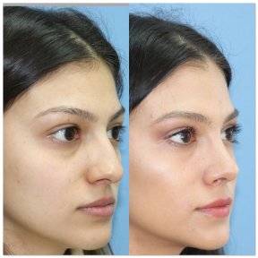 before-after photo rhinoplasty-nose-job