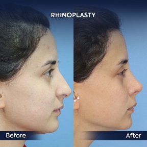 before-after photo rhinoplasty-nose-job