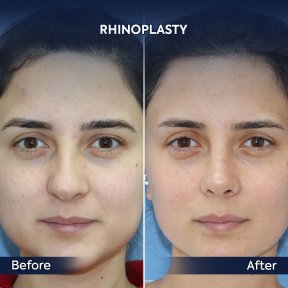 before-after photo rhinoplasty-nose-job