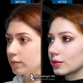 before-after photo rhinoplasty-nose-job