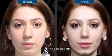 before-after photo rhinoplasty-nose-job