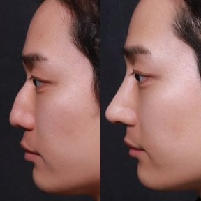 before-after photo rhinoplasty-nose-job