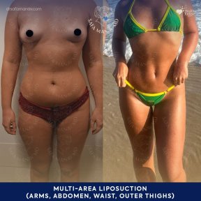 before-after photo rhinoplasty-nose-job