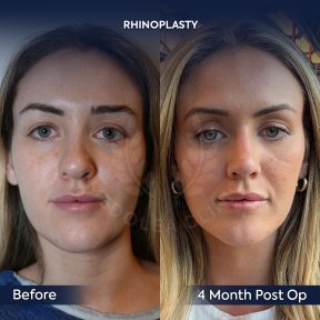 before-after photo rhinoplasty-nose-job