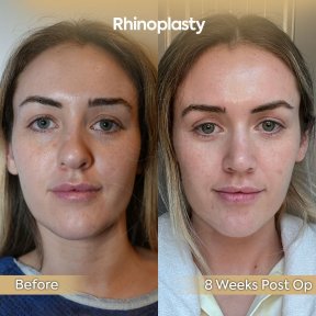 before-after photo rhinoplasty-nose-job