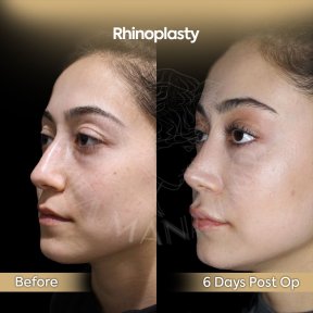before-after photo rhinoplasty-nose-job