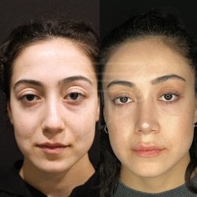 before-after photo rhinoplasty-nose-job