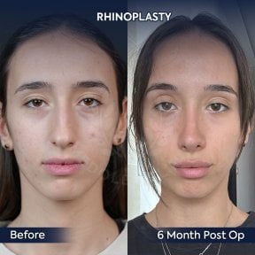 before-after photo rhinoplasty-nose-job