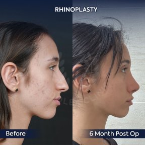 before-after photo rhinoplasty-nose-job