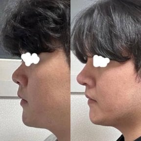 before-after photo rhinoplasty-nose-job