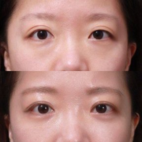 before-after photo blepharoplasty-eyelid