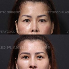 before-after photo cheek-implants