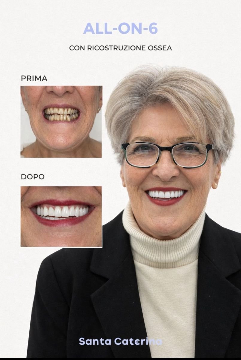 Resultado antes y después de prótesis fija sobre implantes en Santa Caterina Clinic, sonrisa mejorada