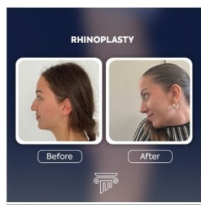 before-after photo rhinoplasty-nose-job