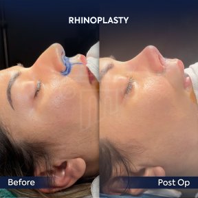 before-after photo rhinoplasty-nose-job