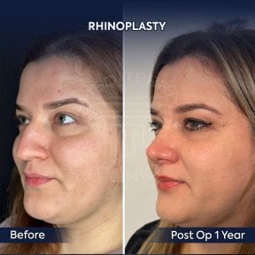 before-after photo rhinoplasty-nose-job
