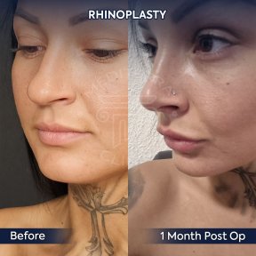 before-after photo rhinoplasty-nose-job